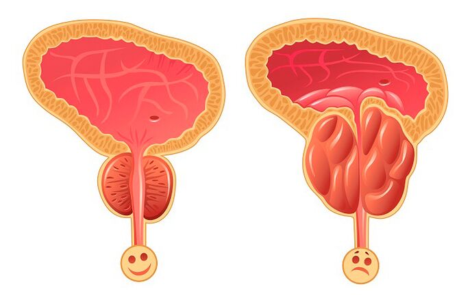 Prostate normale et enflammée