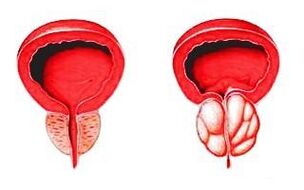 Prostate dans un état normal (à gauche) et enflammée par une prostatite (à droite)