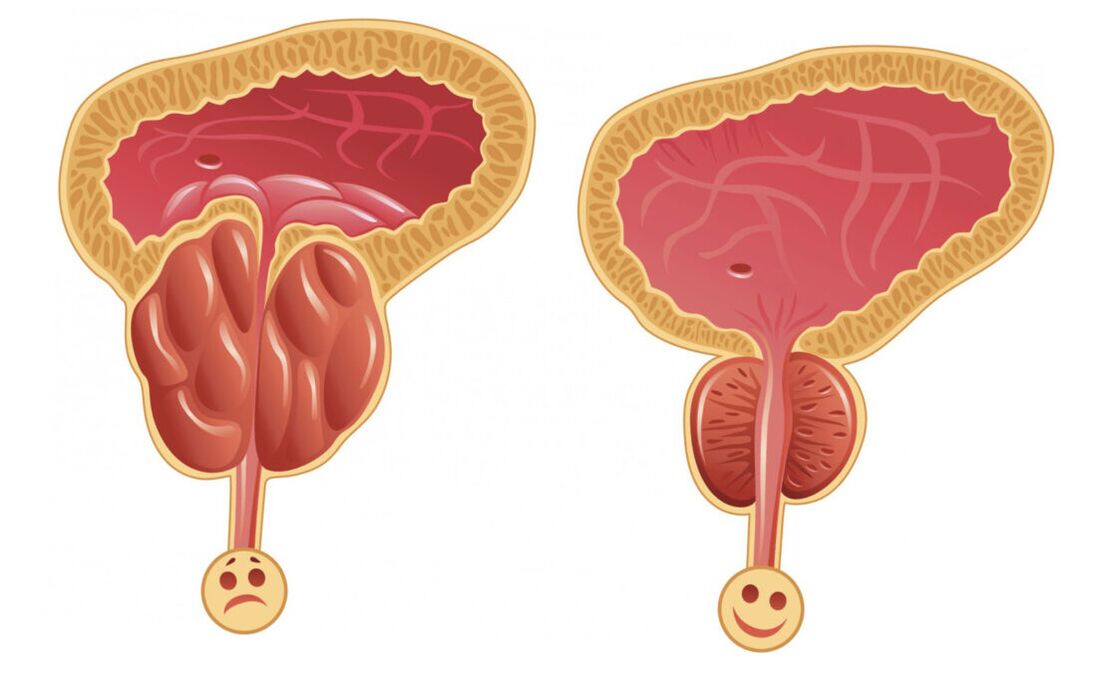 Inflammation de la prostate avec prostatite (à gauche) et la prostate est normale (à droite)