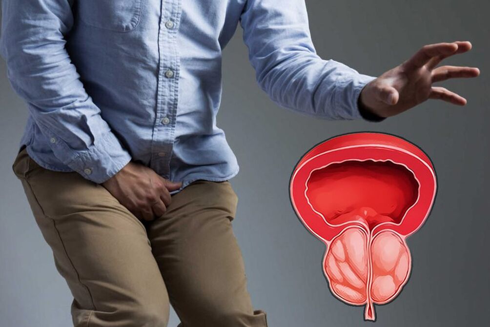 Prostatite chez un homme nécessitant un traitement immédiat