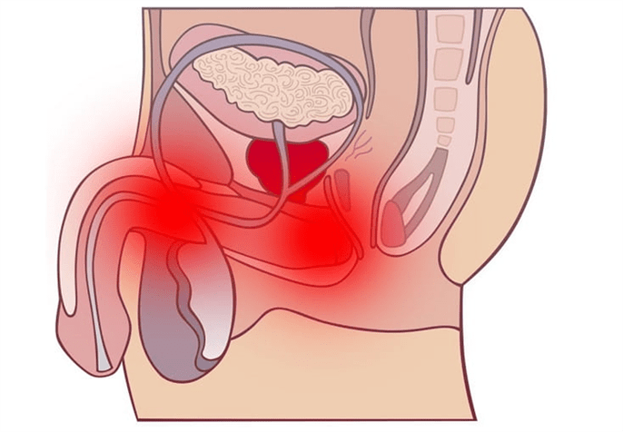 Inflammation des voies génitales avec prostatite